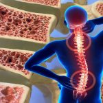 What is osteoporosis?