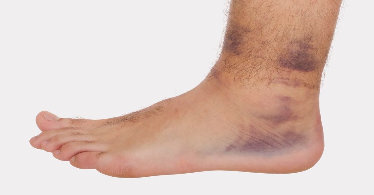Soft Tissue Pain