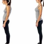 Duruş Bozukluğu Tedavisi