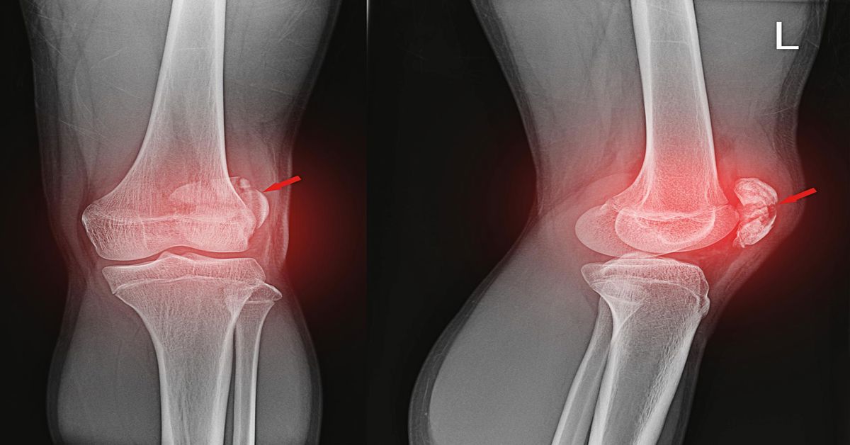 eklem cikigi 2 Eklem Çıkığı Tedavisi