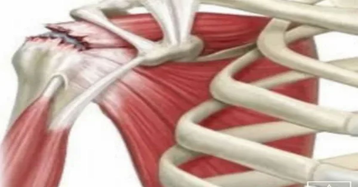 Rotator Manşet Yırtığı Tedavisi