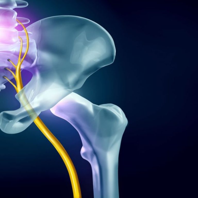 Sciatic Nerve Compression